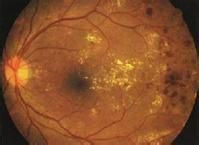 糖尿病性视网膜病变如何治疗?