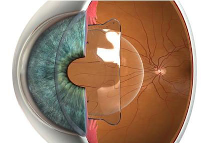 晶体植入手术让高近视患者看清晰