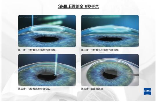 全飞秒激光“微笑”近视手术方式