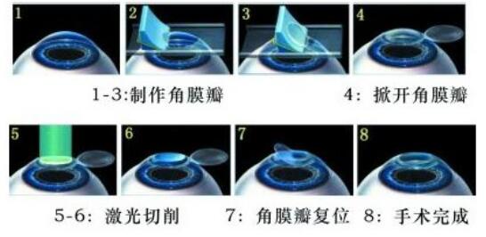 暑期摘镜总动员：近视手术为什么贵？这里才是科普