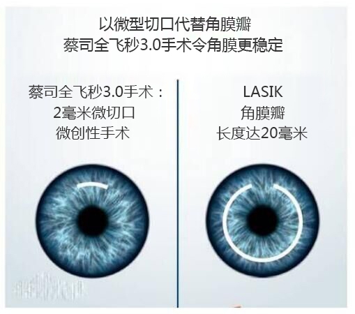 暑期摘镜总动员：近视手术为什么贵？这里才是科普