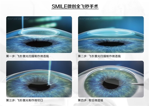 暑期摘镜总动员：近视手术为什么贵？这里才是科普