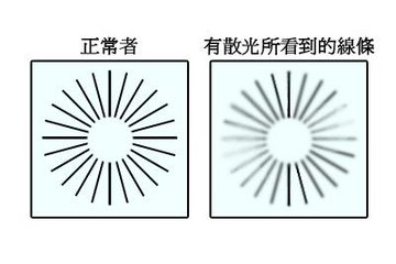 眼睛散光是怎么回事？普瑞眼科专家解析散光治疗