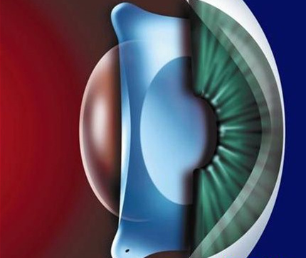 高度近视的危害与治疗方法ICL手术