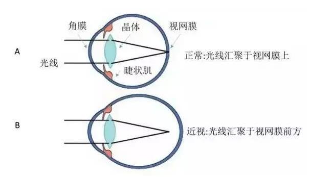 如何判断散光,如何判断散光还是近视