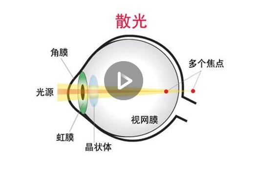 散光看的世界是怎么样的,散光看到的世界