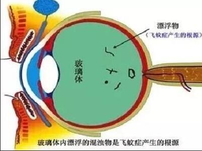 玻璃体混浊是什么